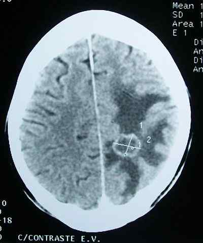 Gejala edema cerebral, sebab dan rawatan