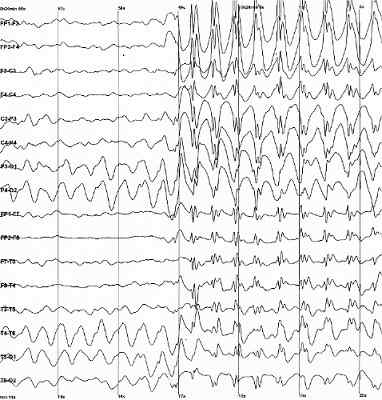 Ajallinen lohkon epilepsiaoireet, syyt, hoito