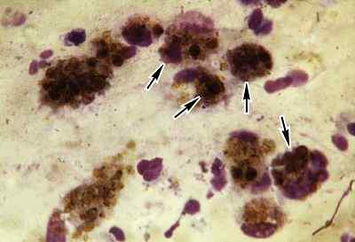 Hososiderina -egenskaper, sjukdomar och diagnos