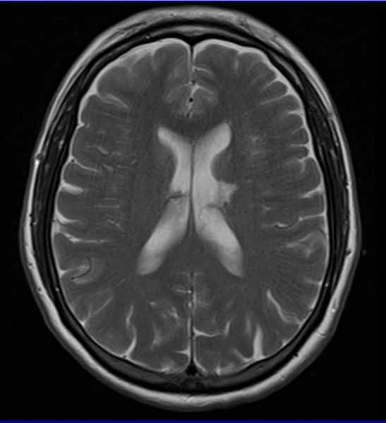 Sintomi di infarto lacunare, cause, trattamenti