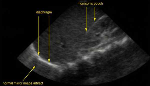 Morison Space Posizione, anatomia, funzioni