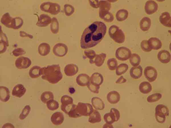 Gejala, penyebab dan perawatan hemoglobin rendah