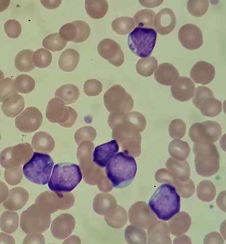 Lymfoblasten