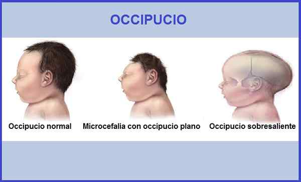 Occipucio -kenmerken, functies, misvormingen