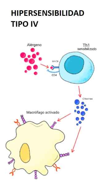 Jenis hipersensitiviti IV