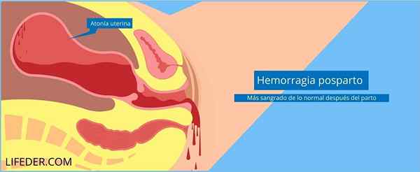 Uterine Atony