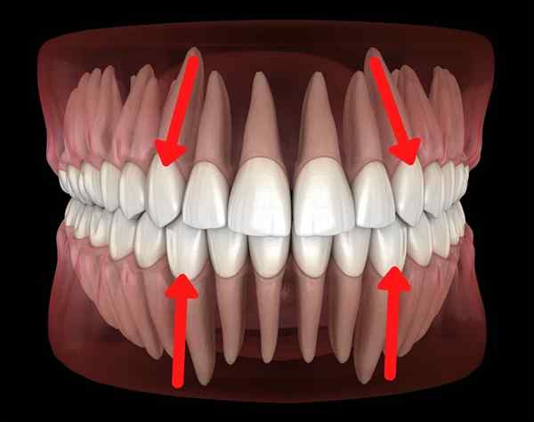 Dentes caninos