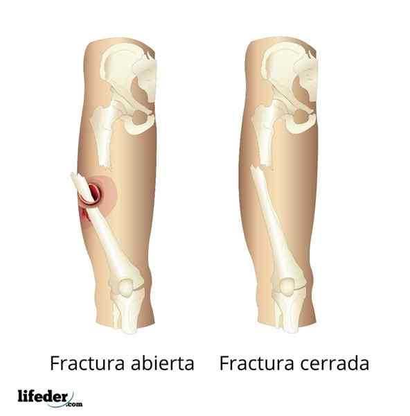 Open fractuur wat is, eerste hulp, behandelingen