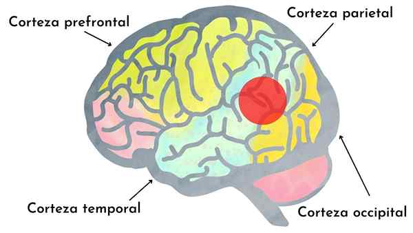 Aphasie du moteur transcortical