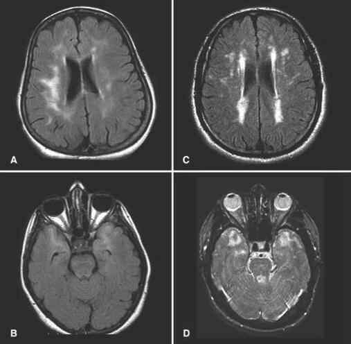 Microangiopathy Cerebral